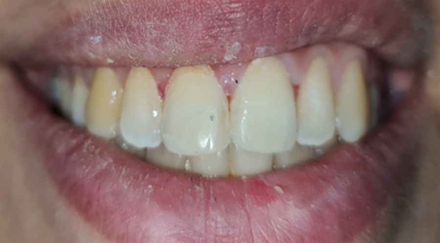 بعد تجميل الاسنان والحشوات التجميل 3